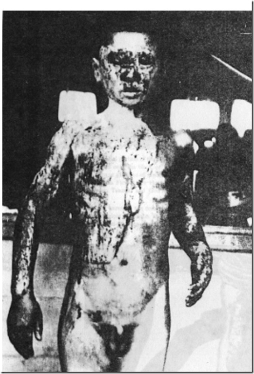 Hiroshima victim 2